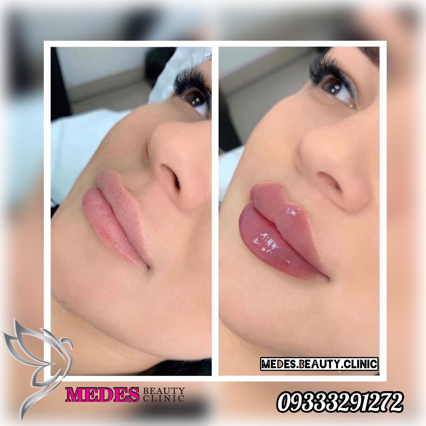 گالری تزریق ژل لب